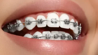 Are Braces Worth It