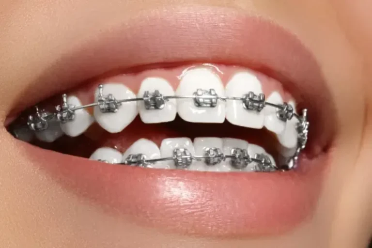 Are Braces Worth It
