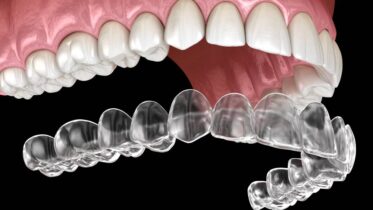 Is Invisalign Worth It